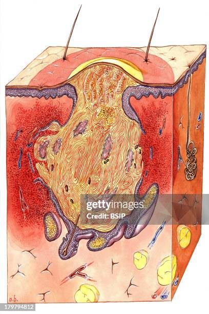Sebaceous Pustules Sebaceous Photos and Premium High Res Pictures - Getty Images