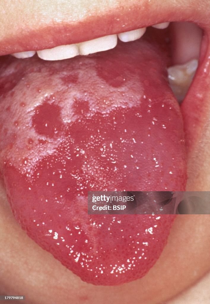 Scarlet Fever