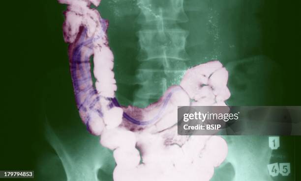 Ascaridiasis, Intestinal Helminthiasis, Ascariasis, On This X-Ray Of An Unprepared Abdomen The Parasite Appears As A Bunch Of Loops On The Left-Hand...