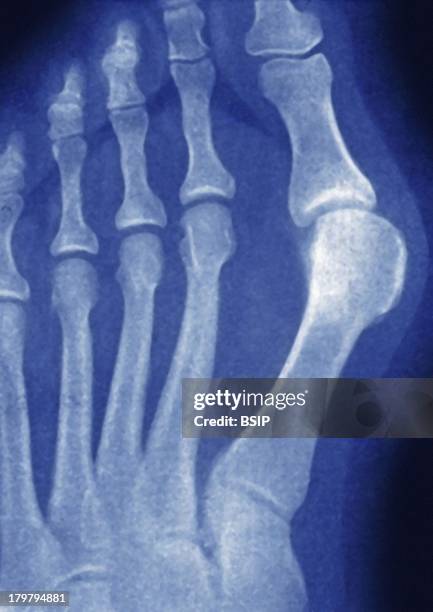 Hallux Valgus, X-Ray, Deviation Towards The Outside Of The Big Toe, Right Foot Front View.