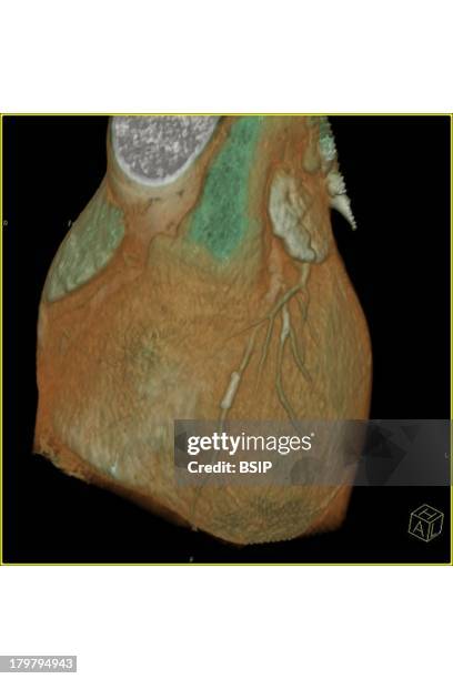 Arterial Angioplasty, Result.