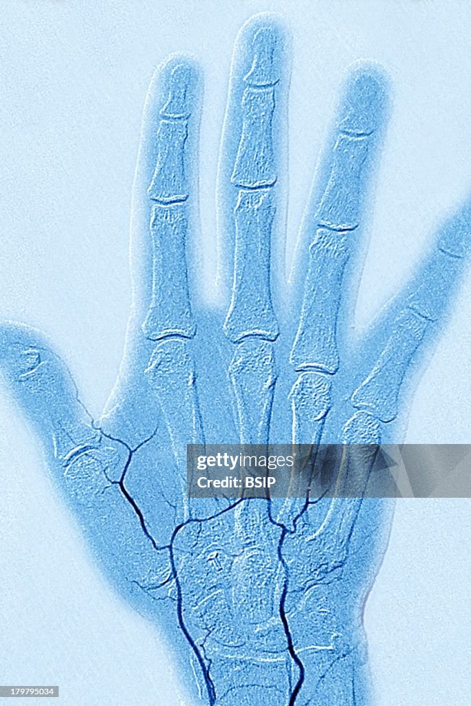 Buergers Disease