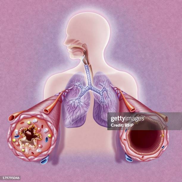 Asthma, Drawing, Bronchial Tubes During And After An Asthma Attack,Male Silhouette With The Lungs And Bronchial Tubes Highlighted, Two Close-Ups Show...