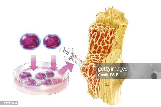 Cell Therapy, Illustration, Bone Marrow.