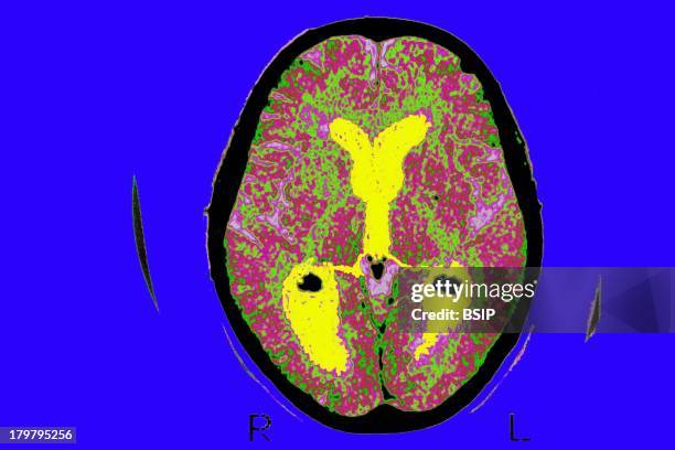 Alzheimer'S Disease, Scan, Brain Of A Patient Affected By Alzheimers Disease, Axial Section, Median Portion Of Dilated Third Ventricle, Symmetrical...