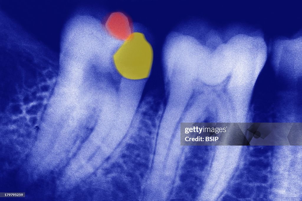 Dental Filling, X-Ray