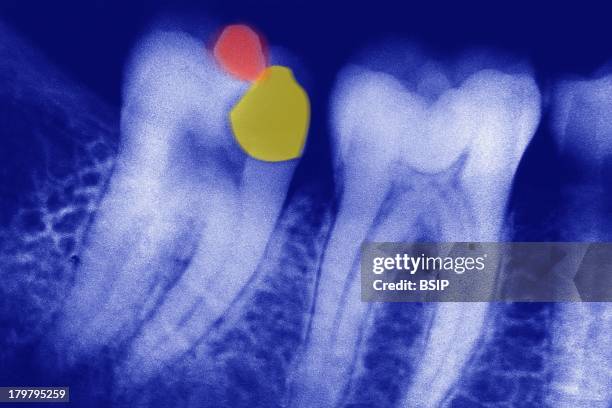 Dental Filling, X-Ray, X-Ray Of Alveolus, Tooth Decay In Yellow And Amalgam Filling In Red.