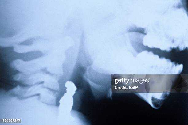 Foreign Body Examples 12 X Ray Foreign Body Stock Photos, High-Res Pictures, and Images ...