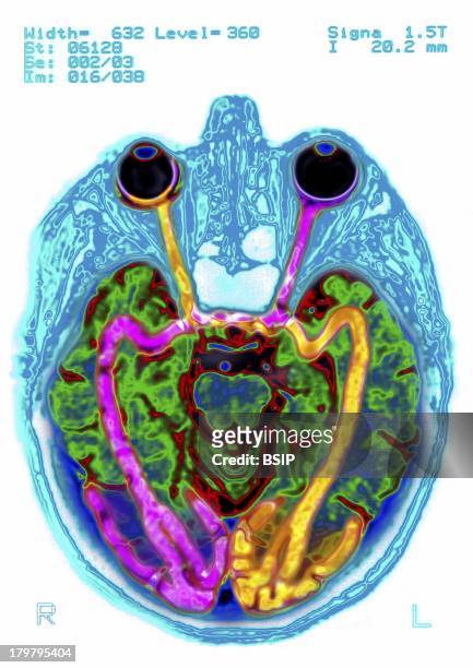 Brain, MRI, Vision And Its Location In The Human Brain, From A MRI Of The Skull, Highlight Of The Eye Balls And The Optic Tract.