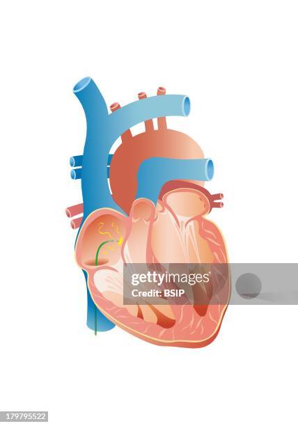 Radiofrequency Ablation.