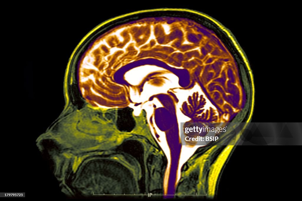 Brain, MRI