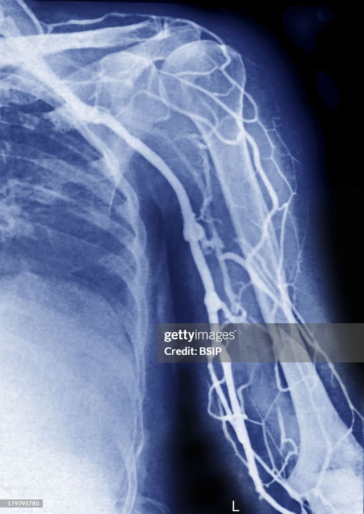 Upper Limb, Angiography