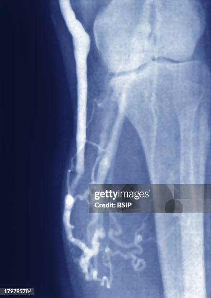 Varicose Vein, Angiography, On The Calf -Sagittal Phlebography.