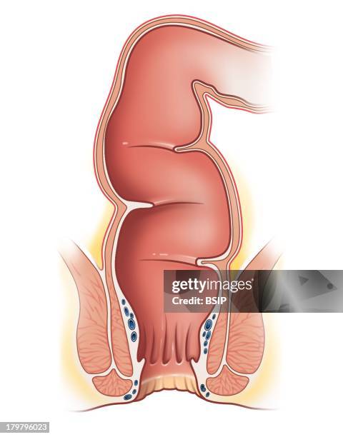 Anus, Drawing, Orifice By Which The Rectum, Which Is The Distal End Of The Colon, Opens Out Of The Body, The Anus Possesses Sphincters Which Enable...