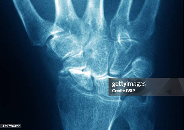 Wrist Osteoarthritis, X-Ray, Post-Traumatic Wrist Arthritis Of Left Hand.