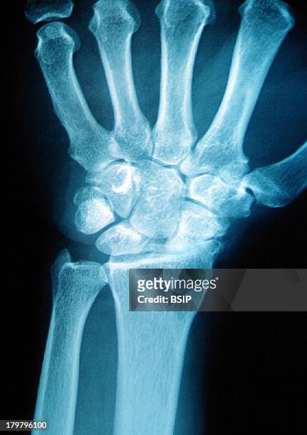 Wrist Osteoarthritis, X-Ray, Post-Traumatic Wrist Arthritis, Of Right Hand.