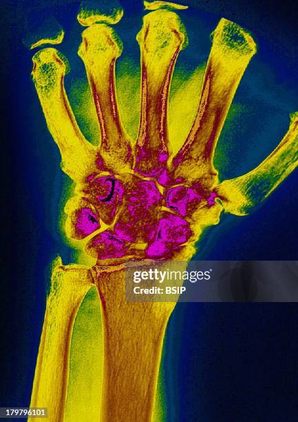 Wrist Osteoarthritis, X-Ray, Post-Traumatic Wrist Arthritis, Of Right Hand.