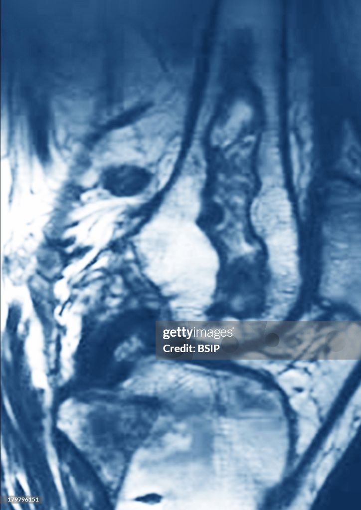 Osteonecrosis Of The Knee Rmn