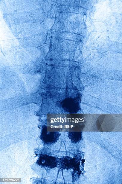 Pagets Disease, X-Ray, Osteoplastic Intervention To Repair Lumbar Vertebrae By Injecting Prosthetic Cement In The Vertebral Disks To Prevent Medullar...