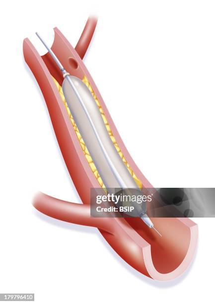 Arterial Angioplasty, Illustration, Example Of The Coronary Artery, The First Step Of The Angioplasty By Balloon Catheter.