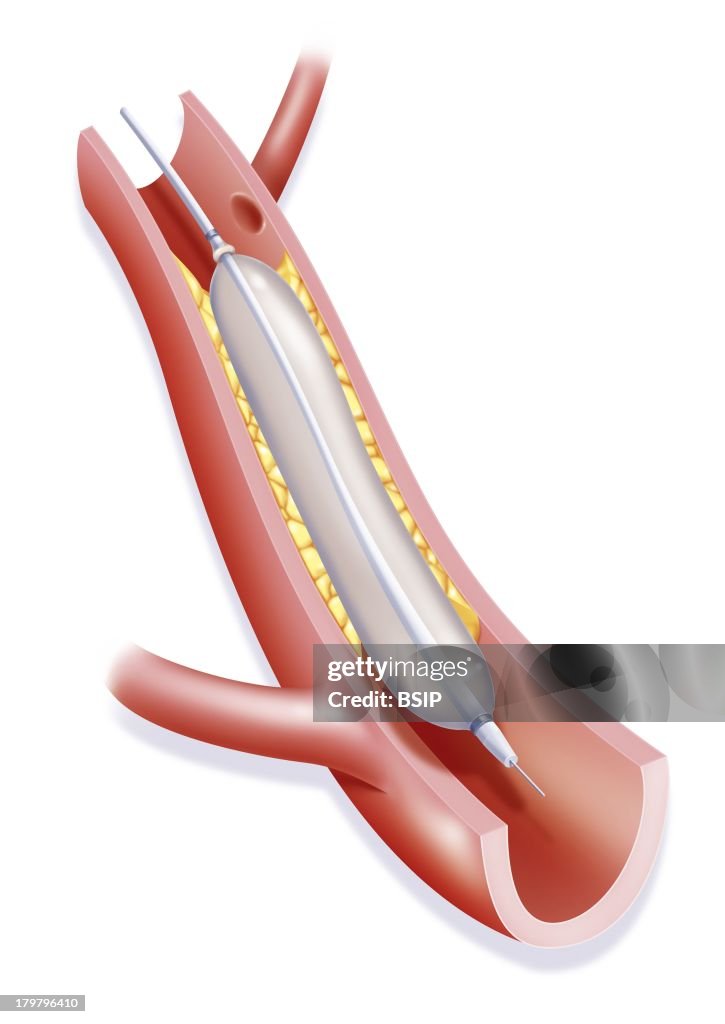 Arterial Angioplasty, Illustration