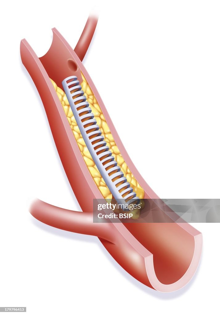 Arterial Angioplasty, Illustration