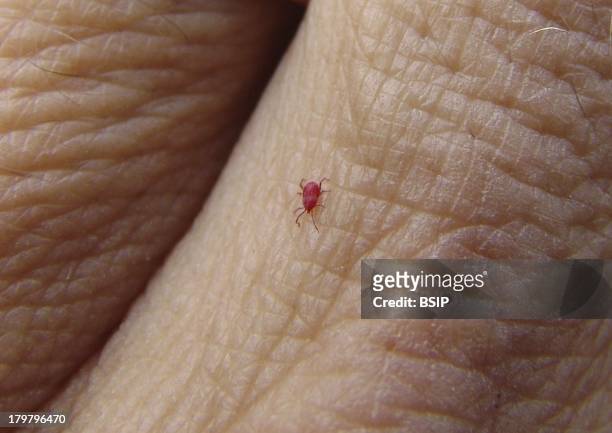 Chigger on hand, A Chigger Is A Red Mite Whose Bite Causes A Benign Dermatosis With Severe Itching.