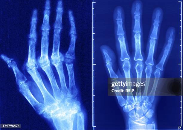 Rheumatoid Arthritis, X-Ray, The Condition Has Caused Ankylosis And Bone Deformation Of The Right Hand, Mainly Women Are Affected By This Disease...