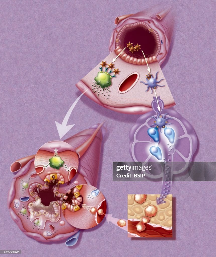Asthma, Drawing