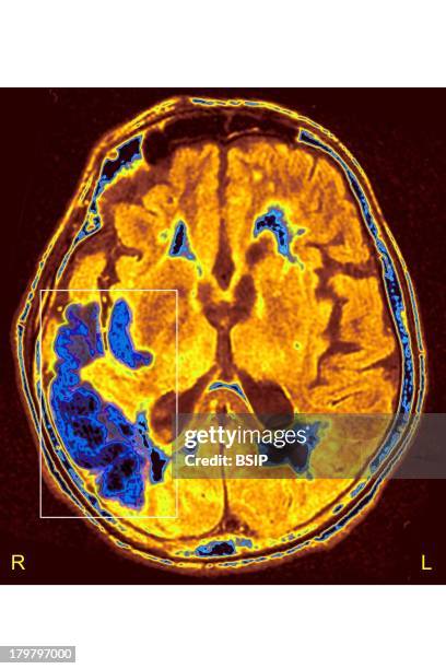 Cerebral Ischemia, Scan, Stroke Due To Arterial Thrombosis In Right Hemisphere, Ct Scan Of Brain, Axial View.