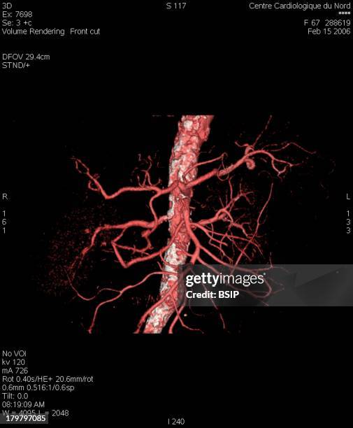 Aorta, 3D Scan, Angiography Scanner 3D, Visualization Of The Aorta And Its Collaterals In The Superior Part Of The Abdomen : Common Hepatic Artery,...