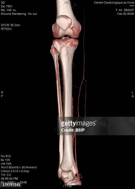 Lower Limb, 3D Scan, Angiography Scanner 3D Of The Right Calf, Visualization Of The Skeleton System, Tibia And Fibula, And Vascularization Of The...