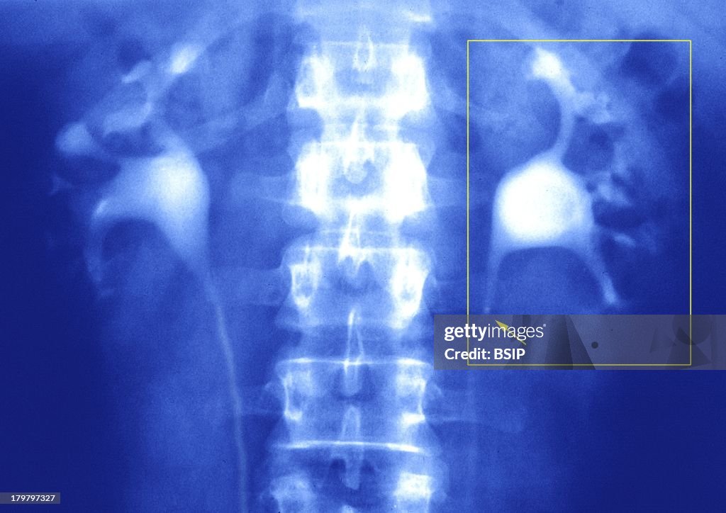 Ureteral Lithiasis, X-Ray