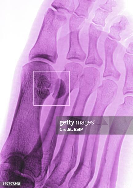 Plantar Wart, Foot X-Ray, Two Warts Between The Big Toe And The Index Of The Right Foot.