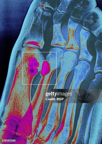 Plantar Wart, Foot X-Ray, Two Warts Between The Big Toe And The Index Of The Right Foot.