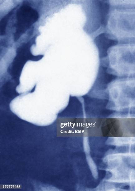 Ureteral Lithiasis, X-Ray, Hydronephrosis Or Nephritic Colic, Distension Of The Renal Pelvis And Calyxes By Accumulation Of The Urine During The...