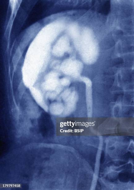 Nephritis, X-Ray, Ascending Nephritis By Microbial Urinary Infection, Visualized By An Urography Of The Right Kidney.