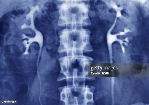 Kidney, X-Ray, Urography In Front View, Normal Kidneys And Ureters.