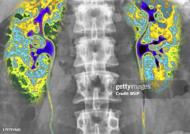 Kidney, X-Ray, Urography In Front View, Normal Kidneys And Ureters.