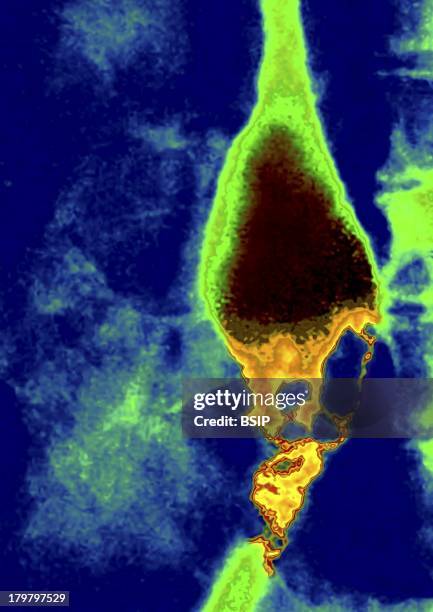 Esophageal Carcinoma, X-Ray, Primary Tumor, Sagittal Thoracic X-Ray.