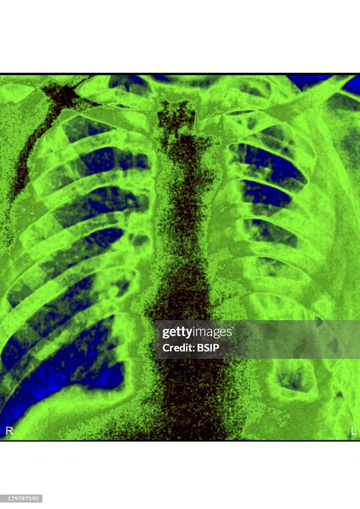 Pyothorax, X-Ray