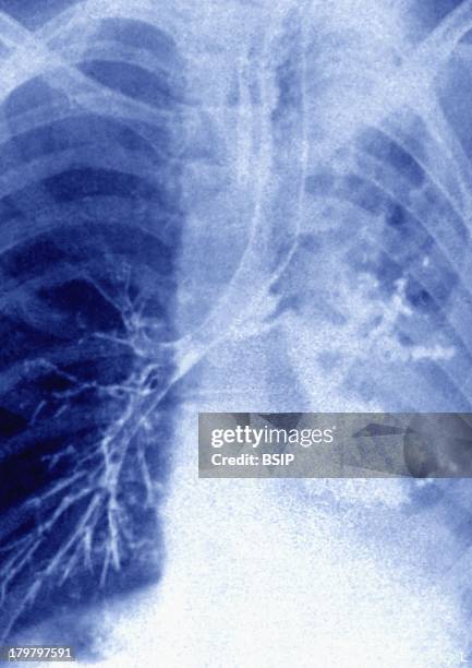 Pulmonary Rupture 795 Lung Damage Stock Photos, High-Res Pictures, and Images - Getty Images