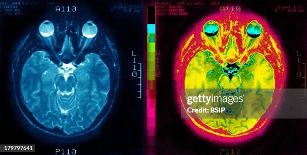 Brain, MRI, Axial Cross-Section.