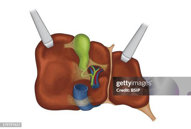 Proper Hepatic Artery Photos and Premium High Res Pictures - Getty Images