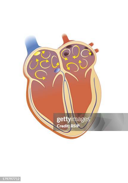 Heart Fibrillation, Illustration.