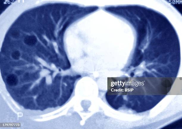 Lung Scan For Emphysema, Pulmonary Emphysema, Axial Thoracic Scanner, Destruction Of Pulmonary Alveoles, It Is A Copd, Most Often Linked To Smoking...