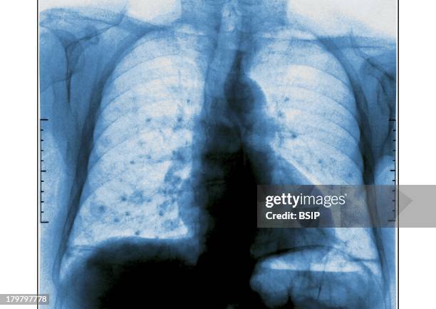 Lung Metastasis, X-Ray, Pulmonary Metastases, Secondary Cancer, Carcinoma, Thoracic X-Ray In Front View.