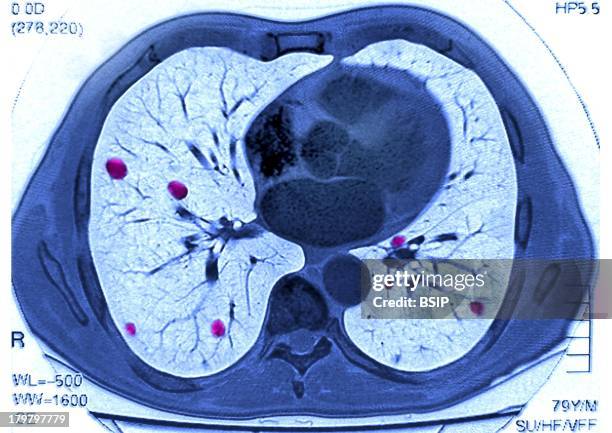 Lung Metastasis, Scan, Pulmonary Metastases, Secondary Cancer, Carcinoma, In A 79-Year-Old Man, Thoracic Scan In Axial Section.