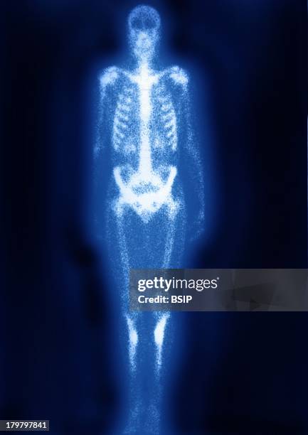 Fatigue Fracture, Scintiscan, Tibial Stress Fractures In An Athlete, Bone Scan.