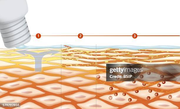 Skin Hydration, Illustration, Effects Of Repair Creams On The Skin To Reconstitute The Barrier Effect Of The Skin, Preventing The Evaporation Of The...